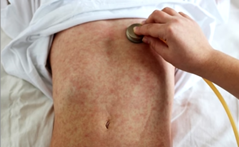 En Oruro reportan el cuarto contagiado de sarampión