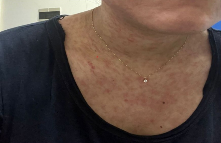 Confirman 4 nuevos casos de sarampión en Santa Cruz y mantienen la alerta roja sanitaria