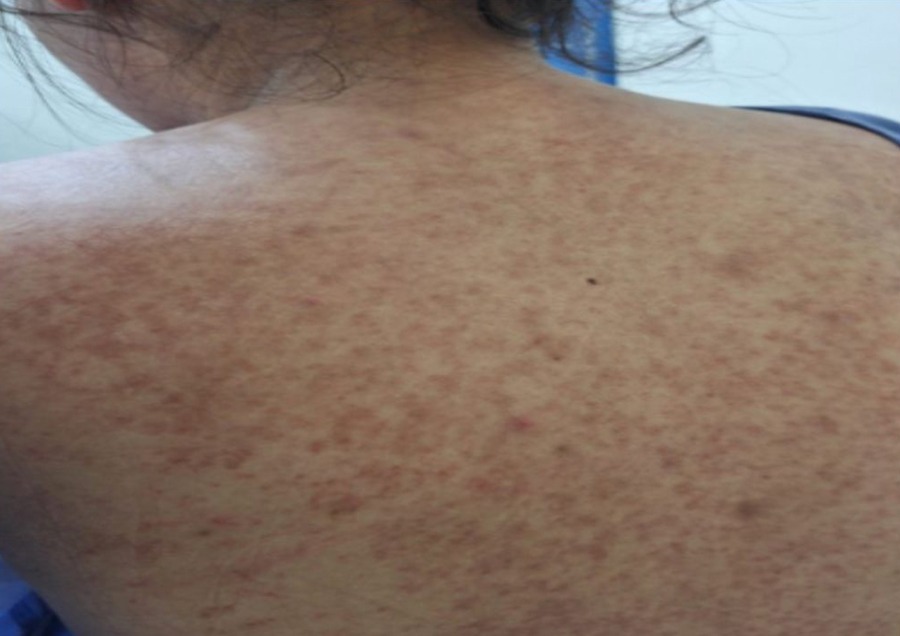 Reportan caso sospechoso de sarampión en Beni