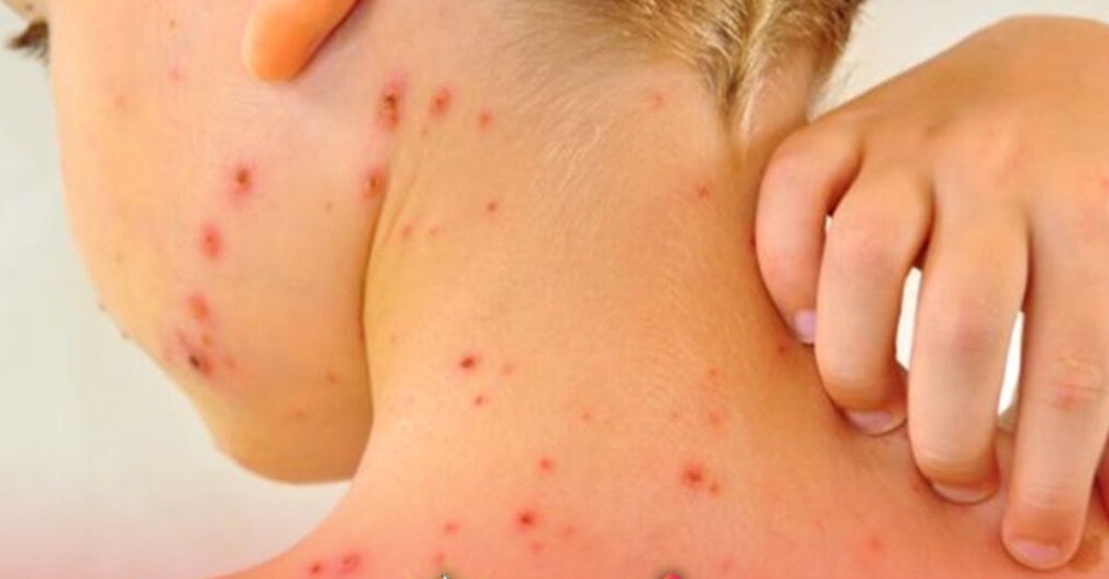 Primer caso de sarampión en El Alto, paciente asistió a evento masivo en Santa Cruz