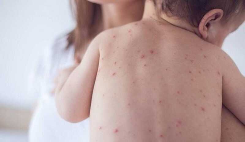 Salud recomienda 11 medidas para cuidar a una persona con sarampión