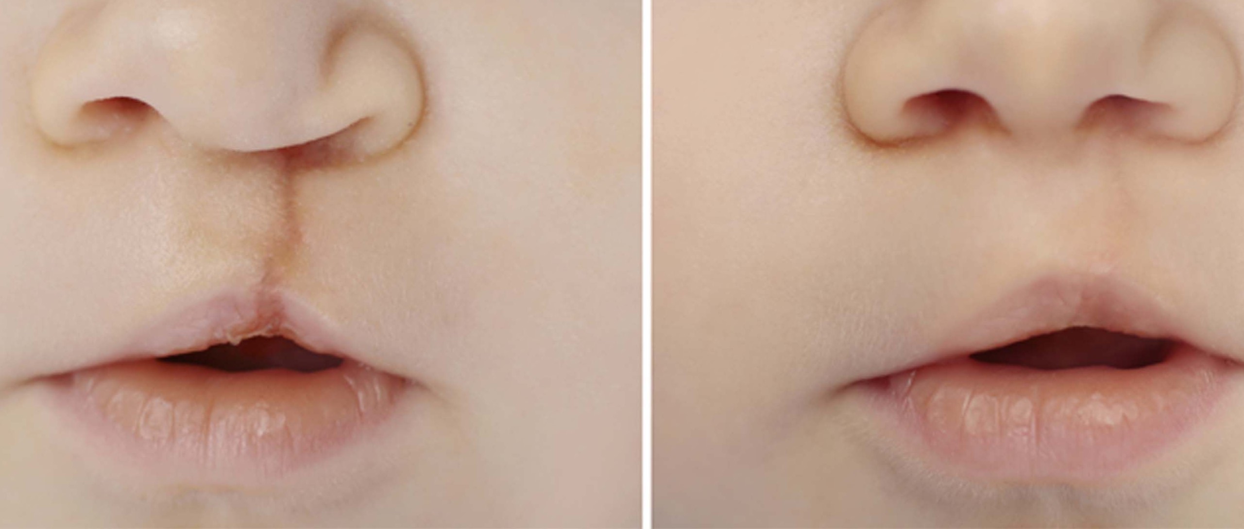 Campaña Creamos Sonrisas beneficiará a niños con fisura de labio en Shinaota